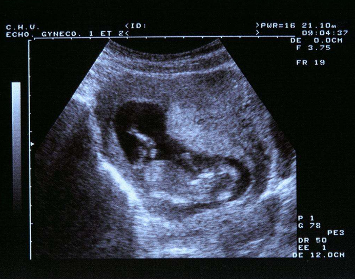 甲狀腺激素減少對懷孕有什么影響 懷孕甲減會流產嗎 甲狀腺激素減少對懷孕有什么影響 懷孕甲減會流產嗎