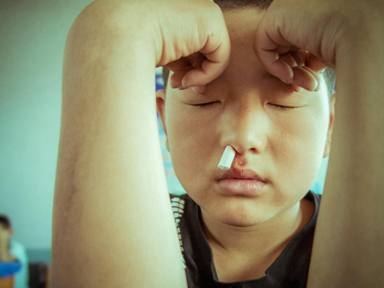 孩子流鼻血怎么做比較好 孩子流鼻血正確處理方法
