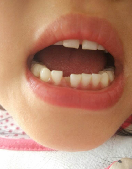 孩子的乳牙不整齊要不要矯正 孩子牙齒不整齊什么時候矯正比較好 孩子的乳牙不整齊要不要矯正 孩子牙齒不整齊什么時候矯正比較好