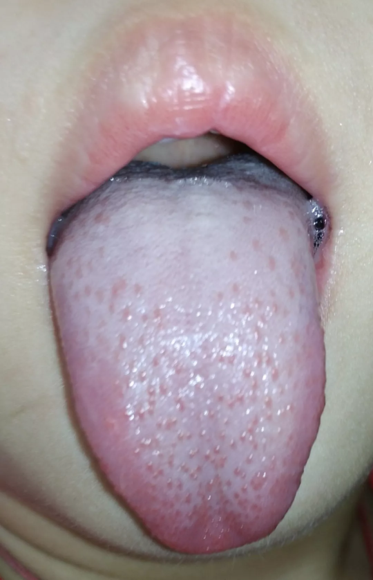 孩子積食用什么方法調理好 孩子積食嚴重吃什么改善