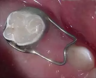 孩子的乳牙提前掉了有什么影響 孩子乳牙提前掉了會怎么樣 孩子的乳牙提前掉了有什么影響 孩子乳牙提前掉了會怎么樣