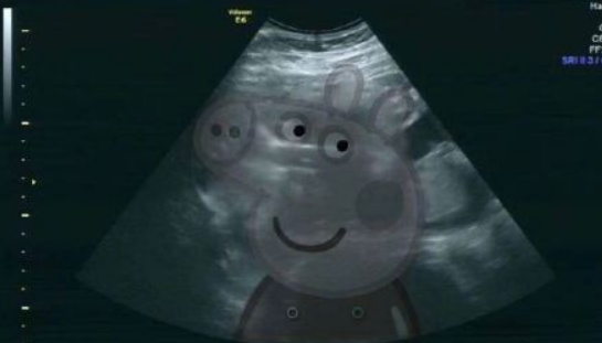 張歆藝懷孕幾個(gè)月了 張歆藝懷孕發(fā)福似吹氣球