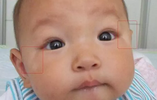 孩子臉上有白斑是肚子有蟲嗎 孩子臉上的白斑是什么原因