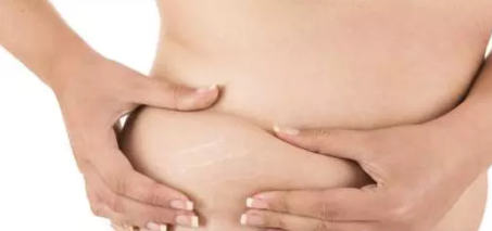 長了妊娠紋怎么辦 如何消除妊娠紋