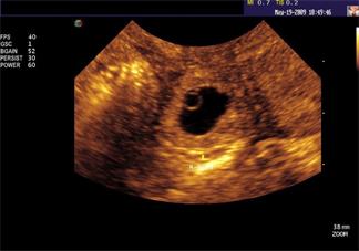 導致懷孕宮外孕的原因是什么 哪些行為會導致宮外孕