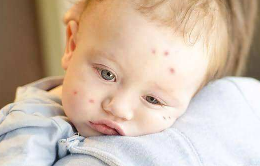 寶寶皮膚癢怎么辦   寶寶皮膚瘙癢有效解決辦法