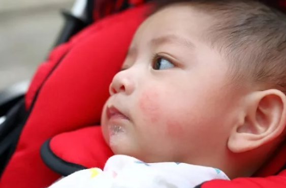 寶寶皮膚過敏解決辦法 寶寶皮膚過敏預防大全 寶寶皮膚過敏解決辦法 寶寶皮膚過敏預防大全