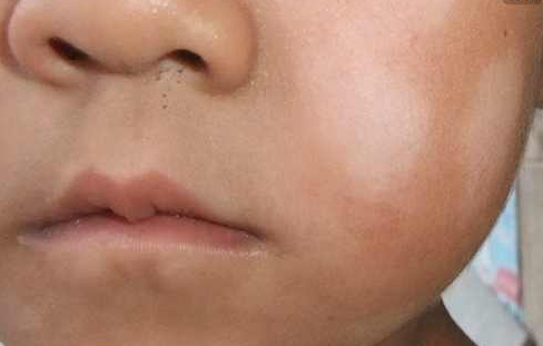 寶寶皮膚白斑怎么辦  寶寶皮膚白斑治療辦法