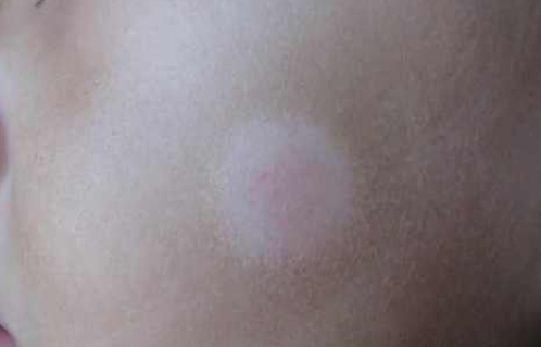 寶寶皮膚白斑怎么辦  寶寶皮膚白斑治療辦法