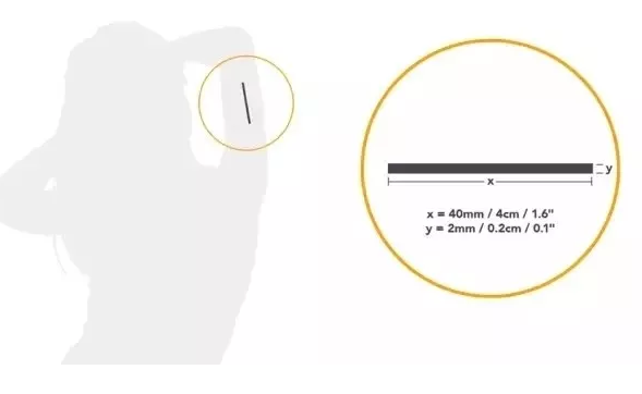 皮下埋線避孕價格 皮下埋線避孕流程傷口圖