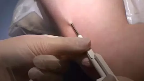 皮下埋線避孕價格 皮下埋線避孕流程傷口圖