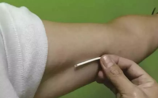 皮下埋線避孕多久取出來 皮下埋線避孕取出來過程