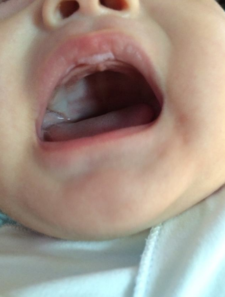 兩個多月寶口臭是什么原因 寶寶口臭怎么改善 