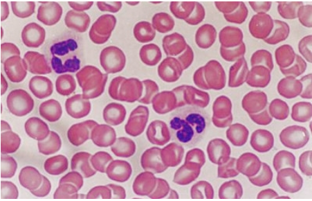 為什么寶寶中性粒細胞偏低 中性粒細胞偏低嚴重嗎 為什么寶寶中性粒細胞偏低 中性粒細胞偏低嚴重嗎