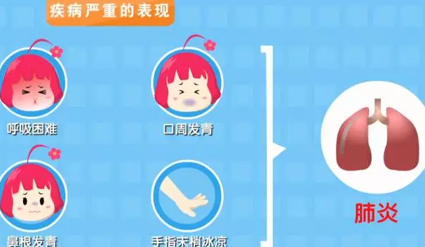 寶寶咳嗽久了會得肺炎嗎 怎么判斷孩子咳嗽是不是肺炎