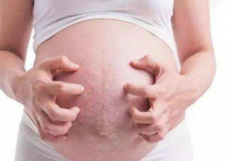 妊娠紋發(fā)癢怎么辦  妊娠紋發(fā)癢解決辦法