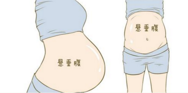 懸垂腹可以順產(chǎn)嗎 為什么會出現(xiàn)懸垂腹 懸垂腹可以順產(chǎn)嗎 為什么會出現(xiàn)懸垂腹