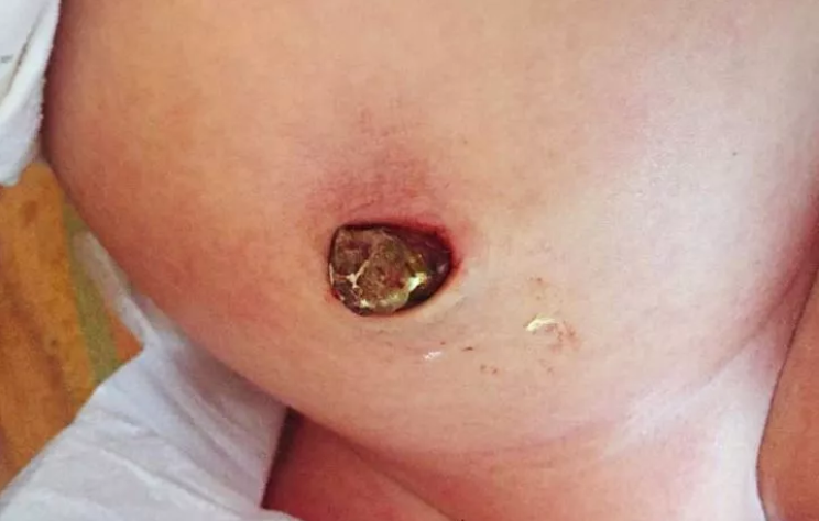 新生兒肚臍發炎怎么辦 新生兒肚臍護理需要注意哪方面的問題