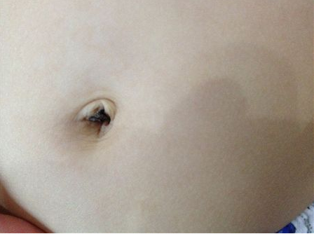 新生兒肚臍發炎怎么辦 新生兒肚臍護理需要注意哪方面的問題