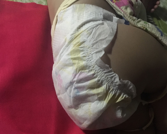 貝+愛紙尿褲會過敏嗎 貝+愛紙尿褲會紅屁股嗎