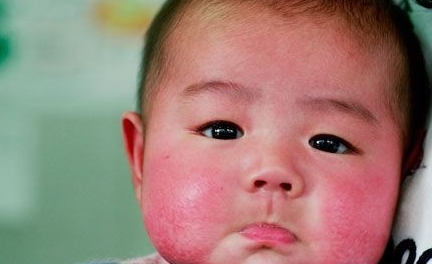 寶寶奶癬怎么治療     寶寶奶癬治療方法