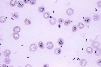 新生兒敗血癥怎么治療   寶寶敗血癥治療方法