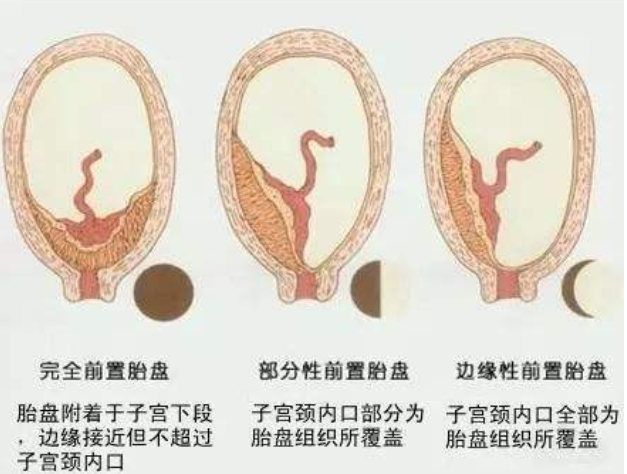 胎盤低置是怎么回事 胎盤低置需要注意什么