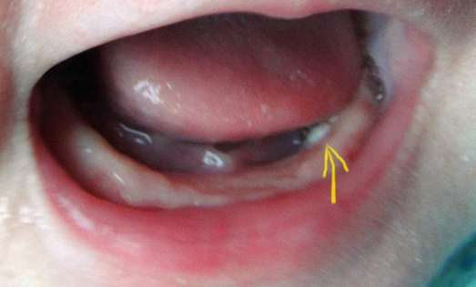 寶寶馬牙和鵝口瘡有什么不同 馬牙和鵝口瘡區(qū)別介紹 寶寶馬牙和鵝口瘡有什么不同 馬牙和鵝口瘡區(qū)別介紹