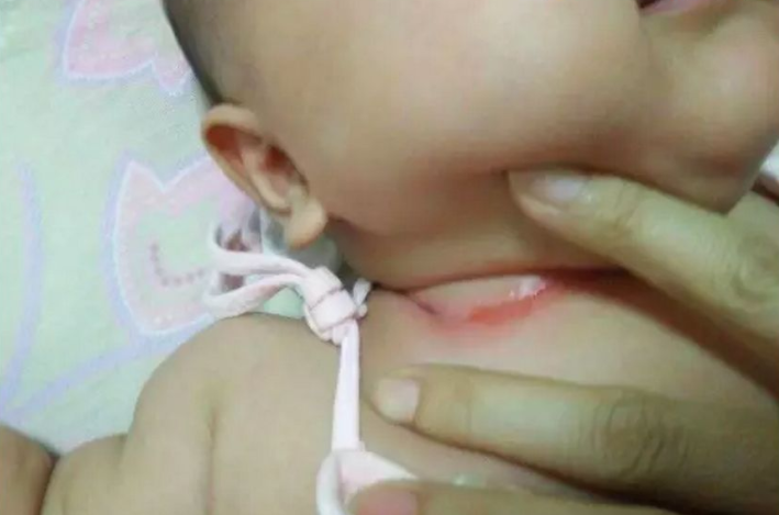 寶寶淹脖子是怎么回事 用山茶油可以治淹脖子嗎