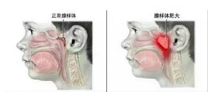 腺樣體肥大什么程度做手術 腺樣體肥大對孩子的影響