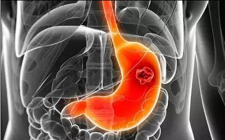 為什么癌癥一發現就是晚期了 死亡率最高的3種癌癥是什么
