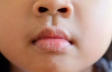 寶寶冬季皮膚護理大全  2018冬季寶寶皮膚護理方法