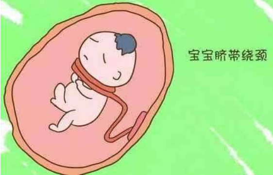 臍帶繞頸能順產嗎 臍帶繞頸兩周可以脫開嗎 臍帶繞頸能順產嗎 臍帶繞頸兩周可以脫開嗎