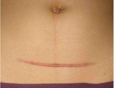 剖腹產(chǎn)疤痕增生怎么回事 疤痕增生用什么藥好 剖腹產(chǎn)疤痕增生怎么回事 疤痕增生用什么藥好