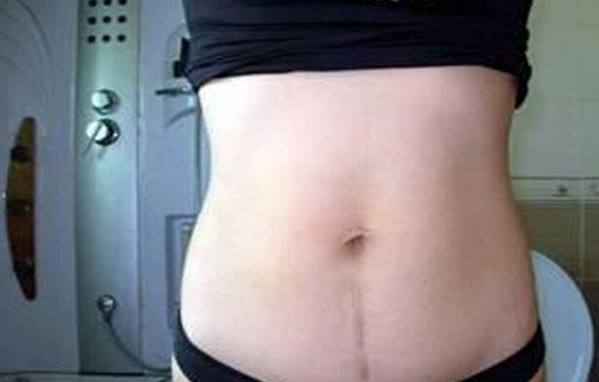 剖腹產(chǎn)疤痕增生怎么回事 疤痕增生用什么藥好 剖腹產(chǎn)疤痕增生怎么回事 疤痕增生用什么藥好