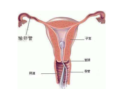 什么時候做輸卵管通液合適 輸卵管通液靠譜嗎