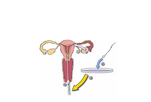 什么時候做輸卵管通液合適 輸卵管通液靠譜嗎