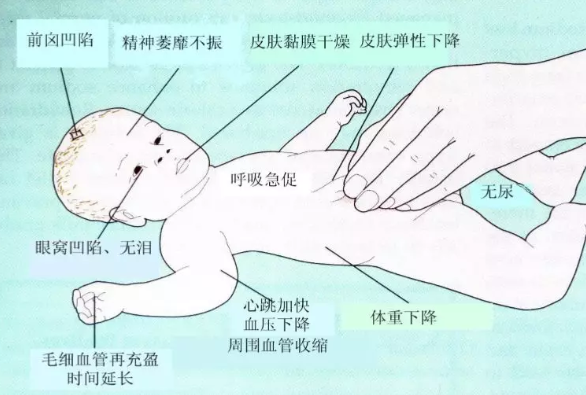 寶寶得了諾如病毒脫水怎么辦 小孩諾如病毒脫水癥狀