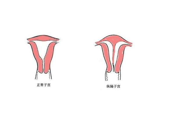 子宮縱膈可以懷孕嗎 子宮縱膈是什么原因引起的