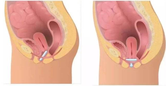 子宮脫垂對女性有什么危害 子宮脫垂吃什么食物好