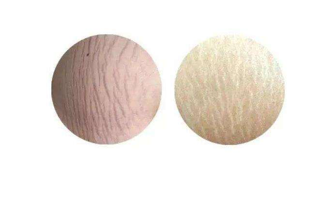 肥胖紋怎么消除 出現肥胖紋是怎么回事