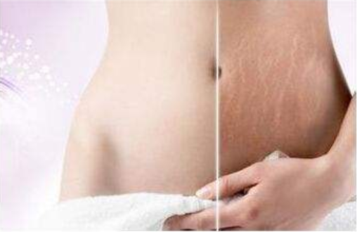肥胖紋怎么消除 出現肥胖紋是怎么回事
