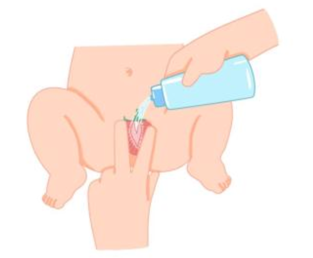 為什么4歲以下的女寶寶容易得小陰唇粘連 寶寶小陰唇粘連怎么預(yù)防