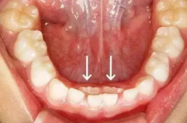 寶寶恒牙長出后錯位怎么辦  恒牙已生乳牙未脫可以拔嗎