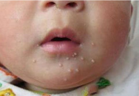 寶寶得了傳染性軟疣怎么辦 傳染性軟疣有什么癥狀