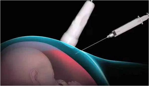 臍帶血穿刺后多久安全 臍帶血穿刺和羊水穿刺有什么區(qū)別