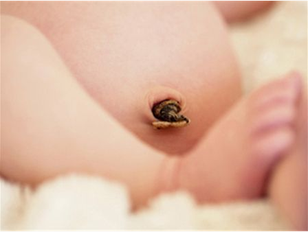 新生兒肚臍感染會導(dǎo)致敗血癥嗎 新生兒肚臍護(hù)理方法