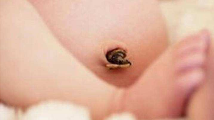 新生兒肚臍感染會導(dǎo)致敗血癥嗎 新生兒肚臍護(hù)理方法