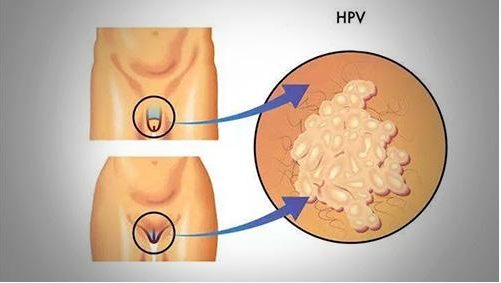 什么是女性假性濕疣 假性濕疣會自行自愈嗎