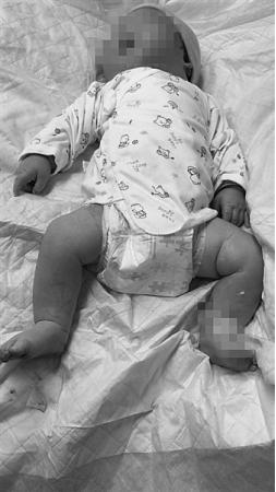 201斤產婦剖宮生了個12斤巨嬰 生下12斤巨嬰是什么情況